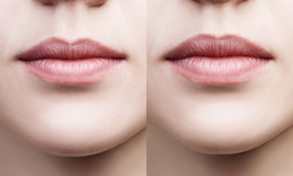 Lèvres chirurgie esthétique montpellier