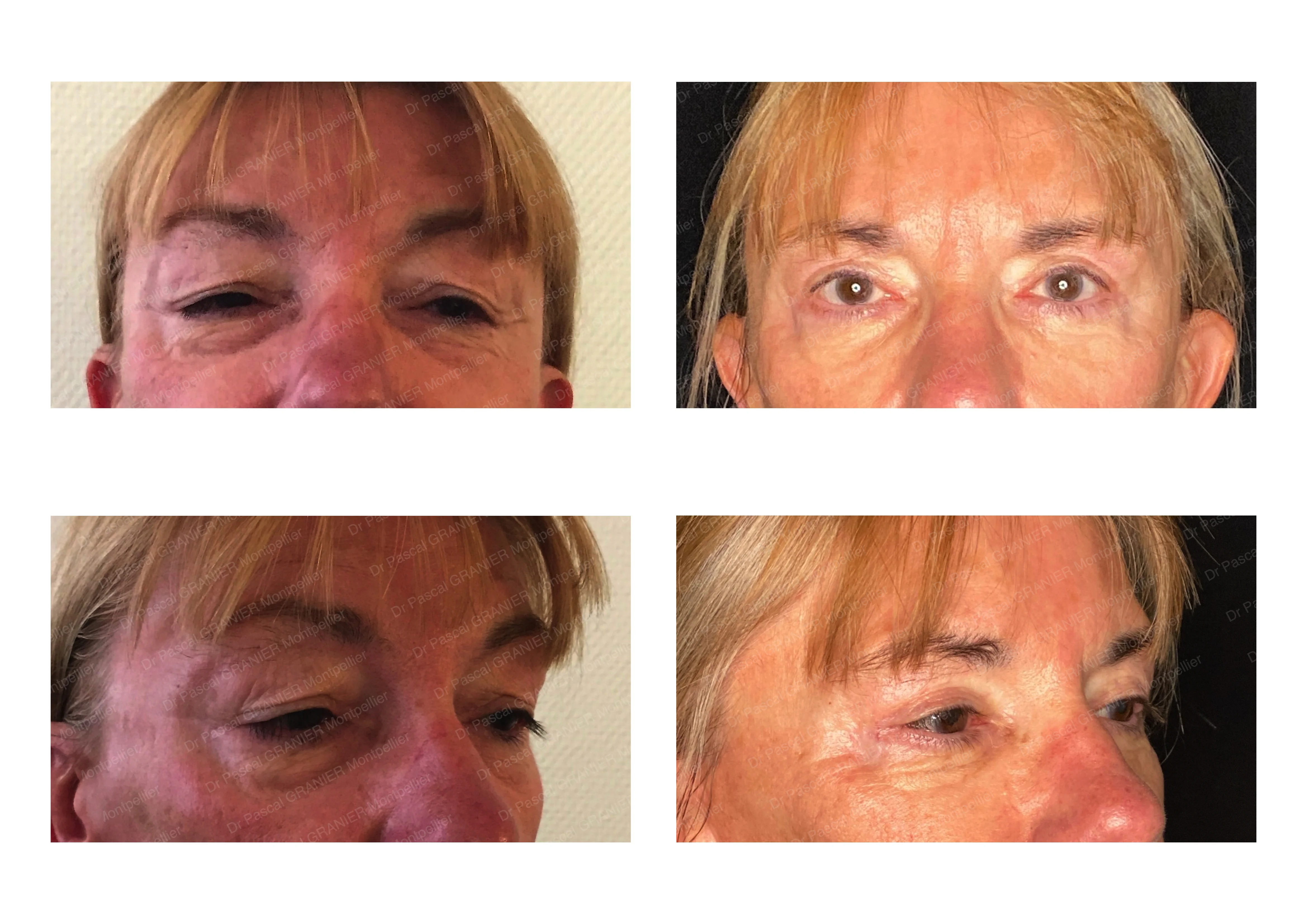 photos avant après Résultat chirurgie Dr Pascal GRANIER : 4 paupières par voie sous-ciliaire - Blepharoplastie