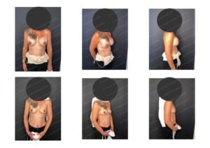 photos avant après Résultat chirurgie Dr Pascal GRANIER : Depose ou retrait d'Implants mammaires