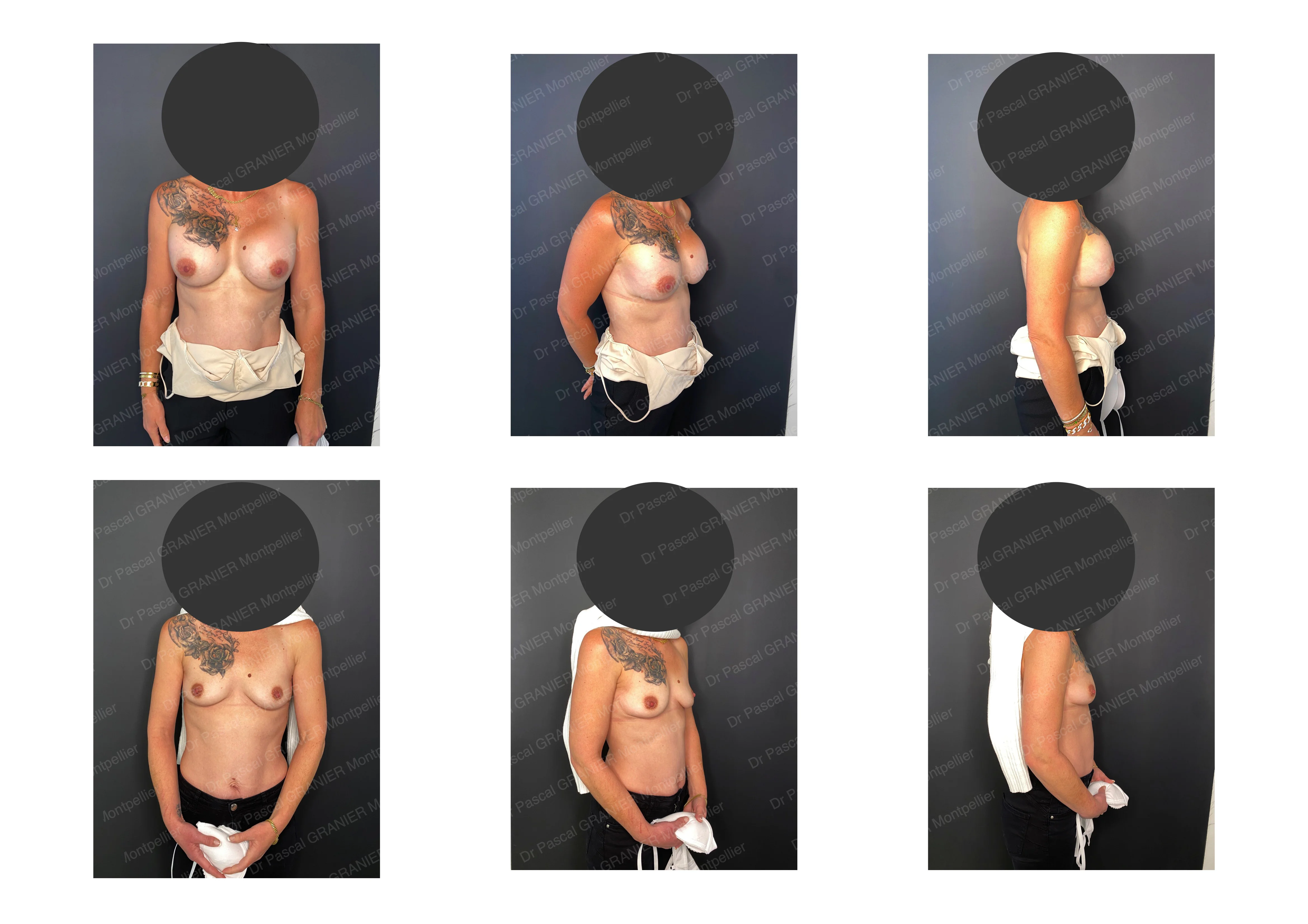 photos avant après Résultat chirurgie Dr Pascal GRANIER : Depose ou retrait d'Implants mammaires
