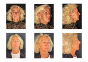 photos avant après Résultat chirurgie Dr Pascal GRANIER : Double Lifting du visage Cervico-facial + Centro-facial