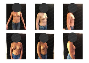 photos avant après Résultat chirurgie Dr Pascal GRANIER : Implants mammaires 330 profil Haut