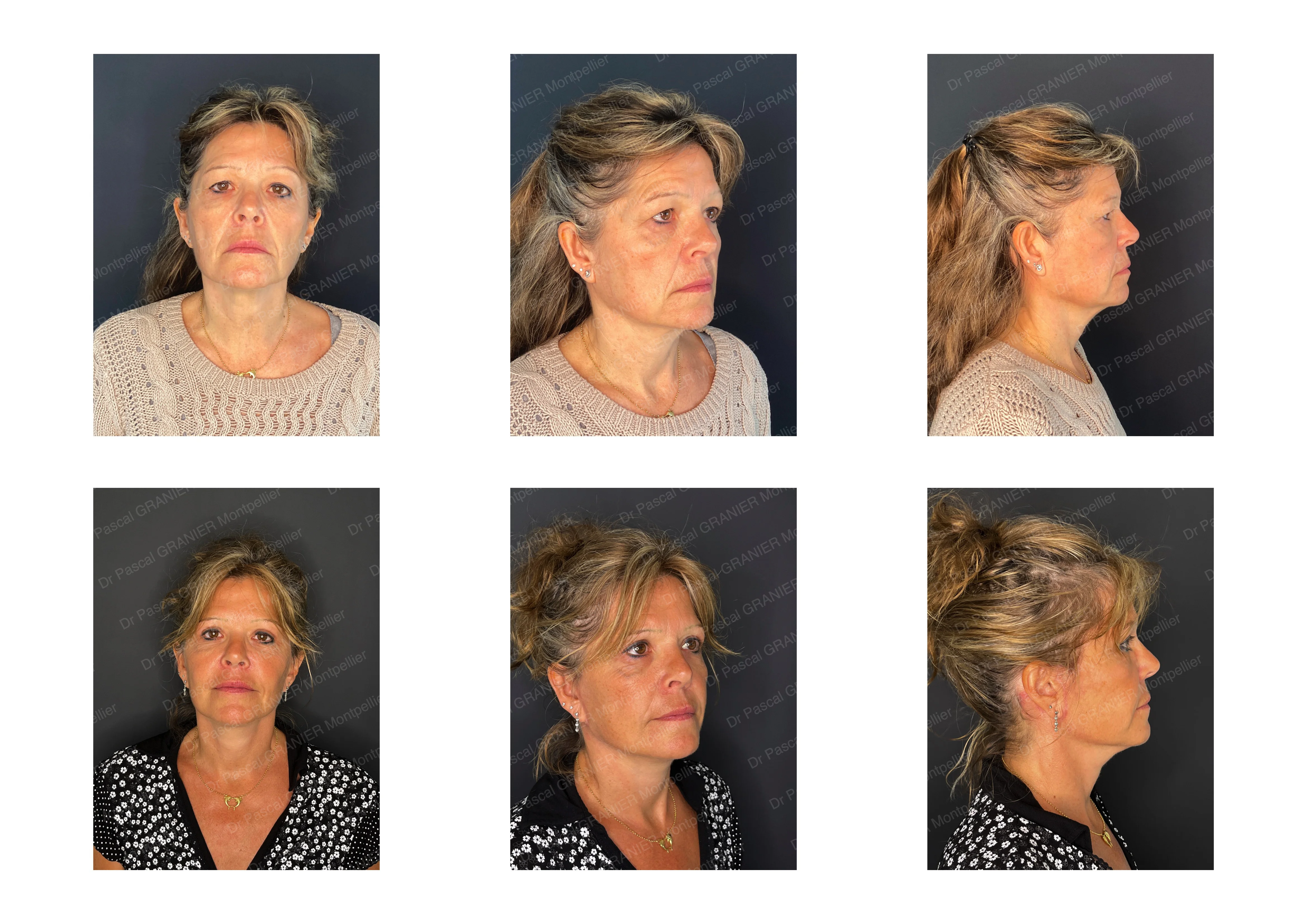 photos avant après Résultat chirurgie Dr Pascal GRANIER : Lifting cervico-facial Naturel + paupières supérieures