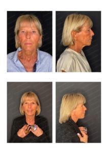 photos avant après Résultat chirurgie Dr Pascal GRANIER : Lifting cervico-facial Naturel + paupières superieures