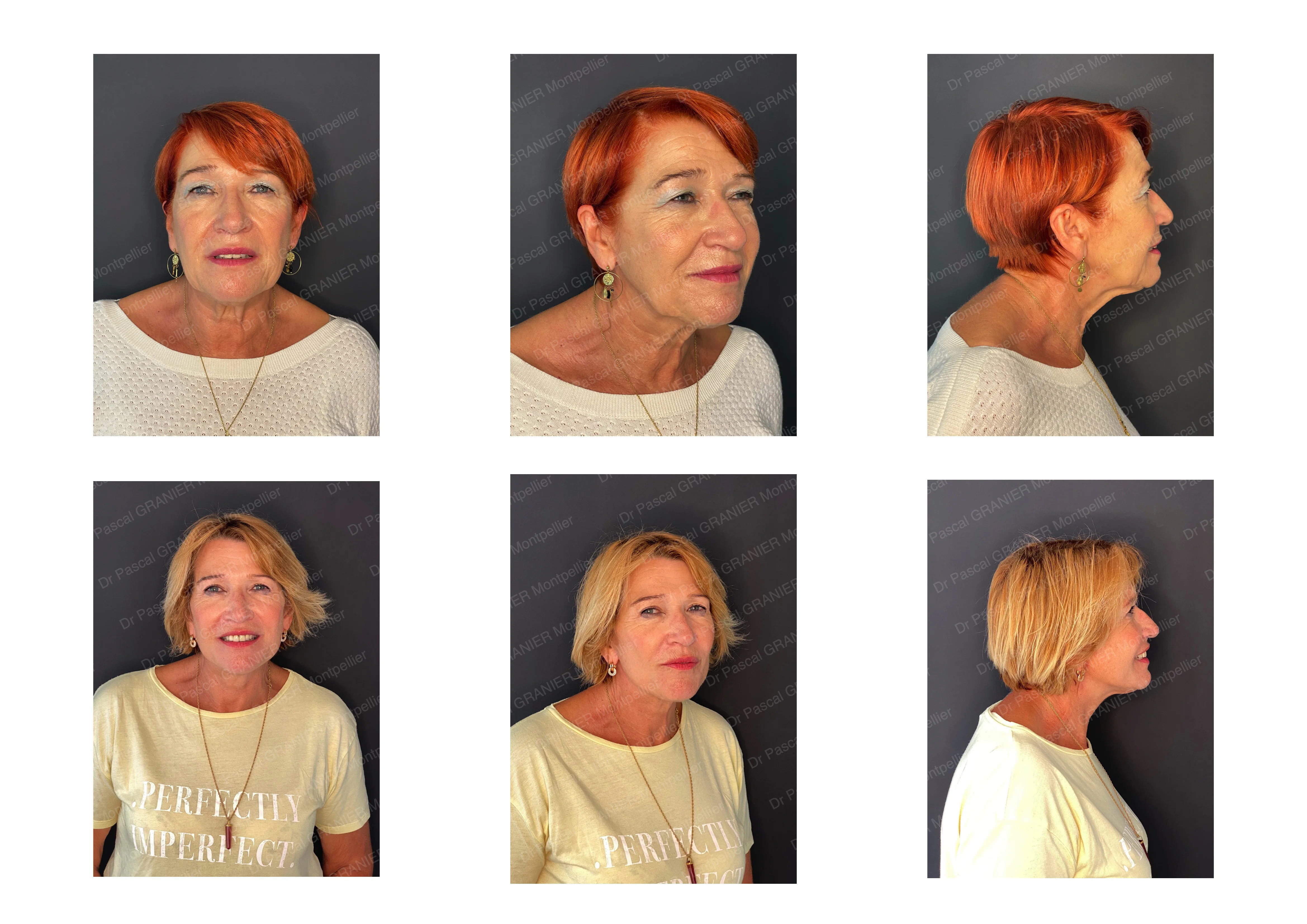 photos avant après Résultat chirurgie Dr Pascal GRANIER : Lifting sous-musculaire du visage + Blépharoplastie supérieure (paupières)