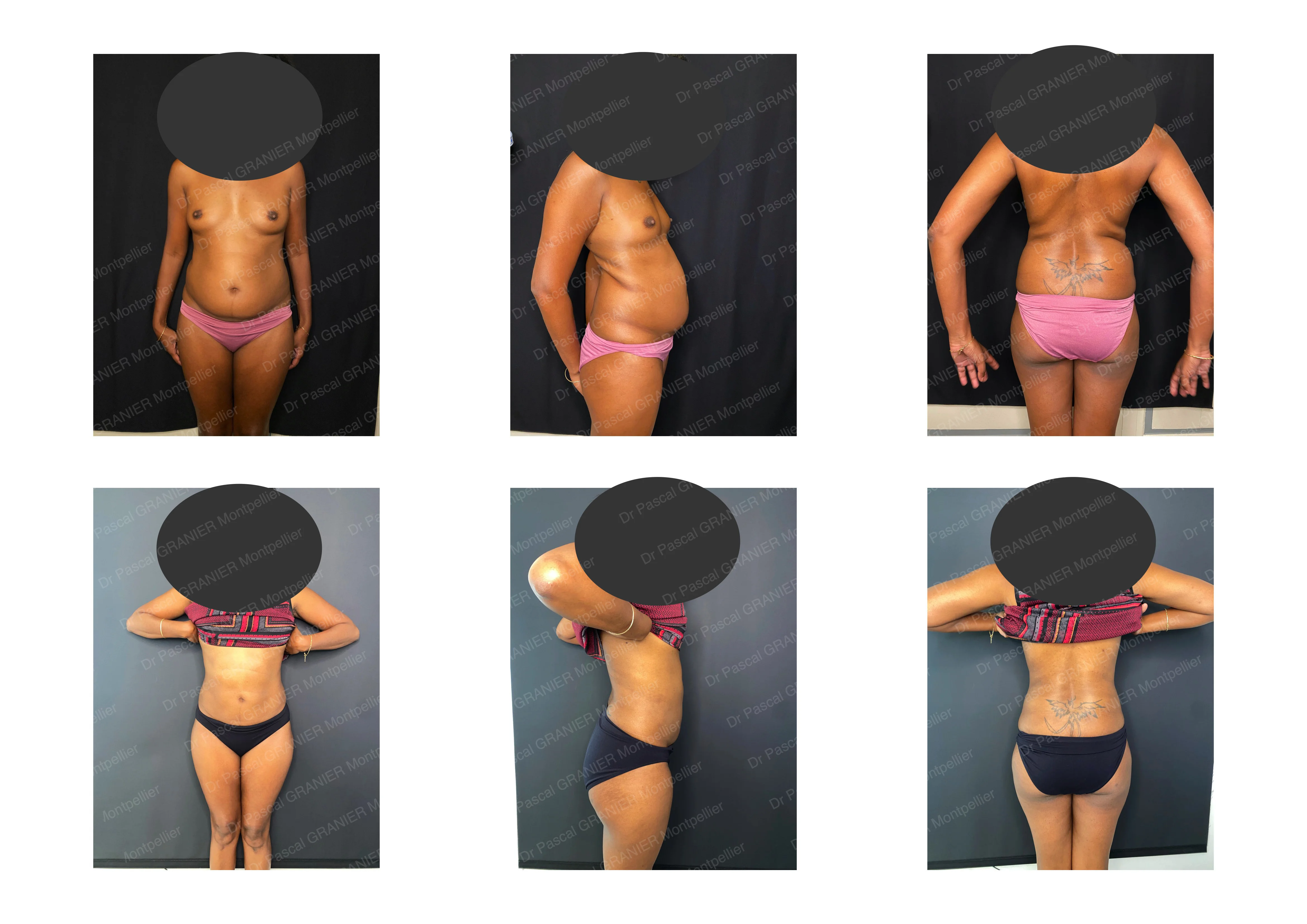 photos avant après Résultat chirurgie Dr Pascal GRANIER : Liposuccion Ventre + flancs