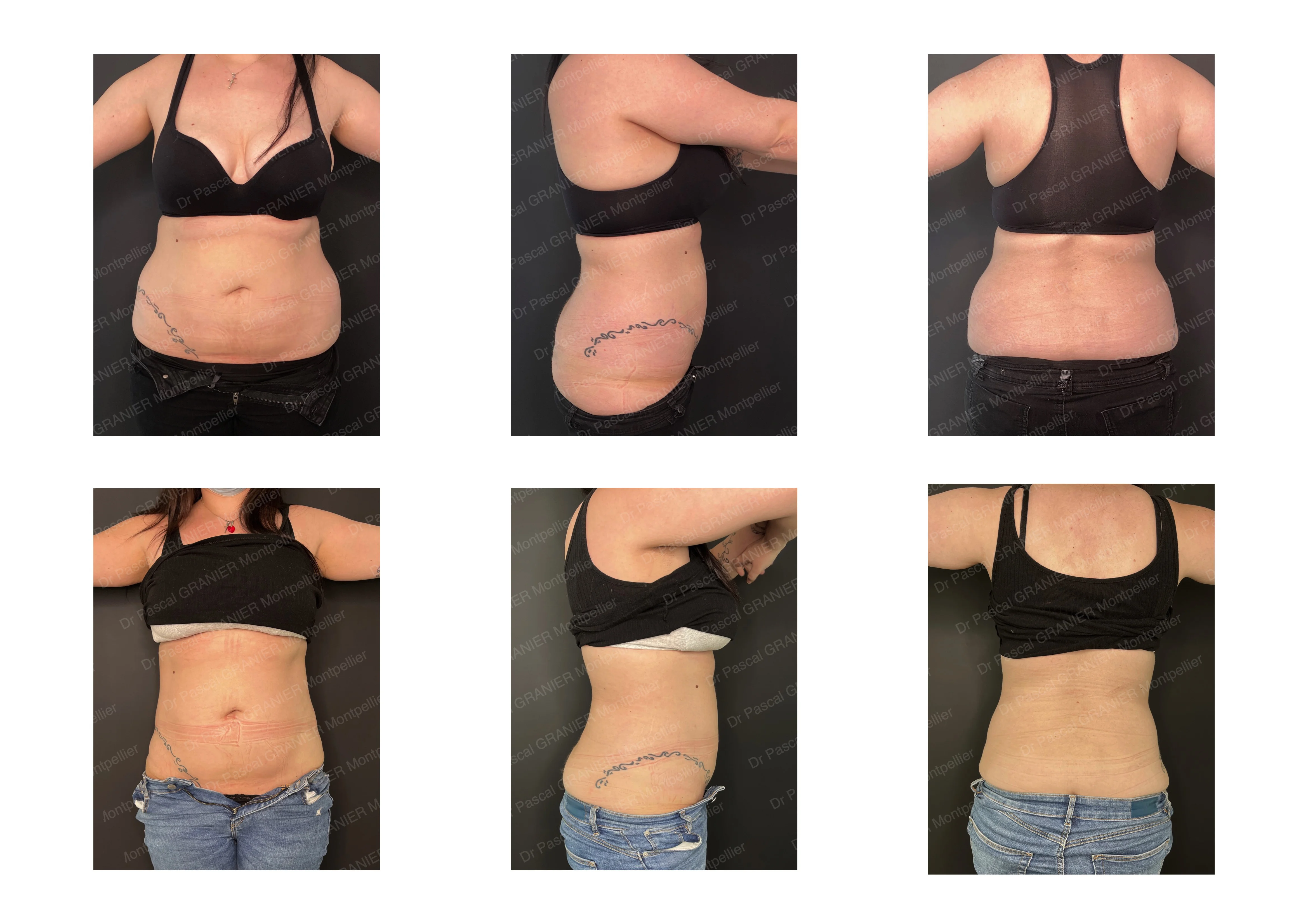 photos avant après Résultat chirurgie Dr Pascal GRANIER : Liposuccion flancs 1500 cc