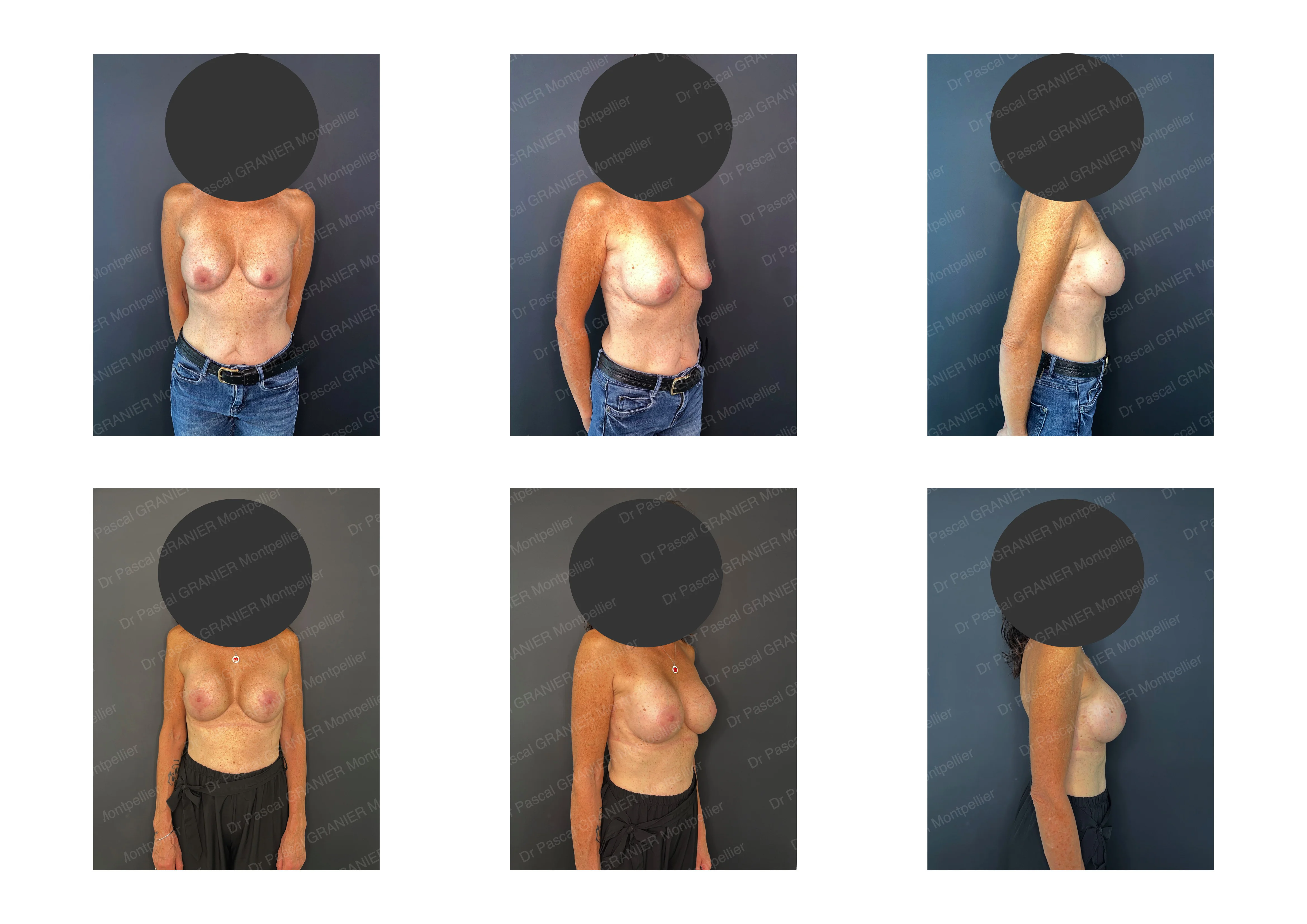 photos avant après Résultat chirurgie Dr Pascal GRANIER : Mastopexie / cure de ptose / Changement de prothèses sur rupture d'implants mammaire