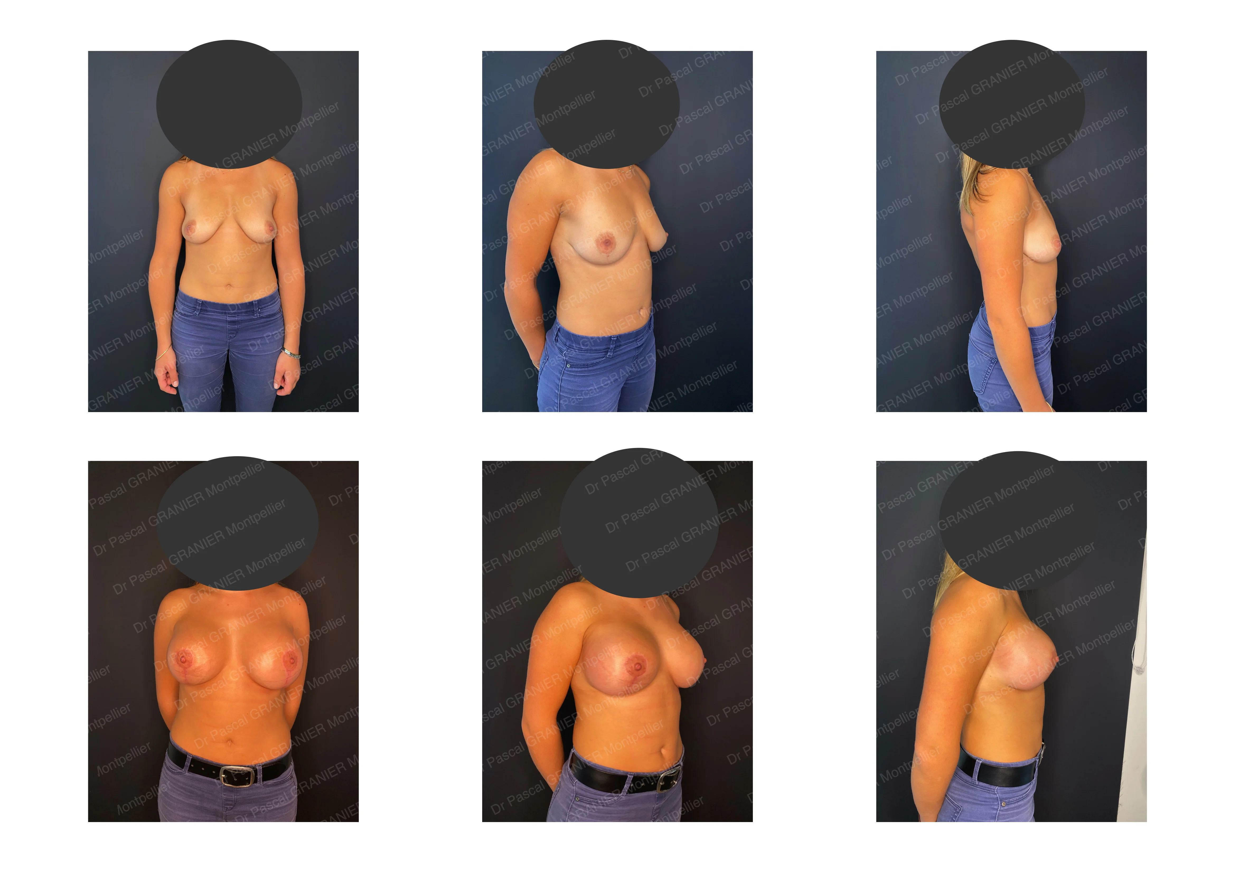 photos avant après Résultat chirurgie Dr Pascal GRANIER : Mastopexie en Ancre de marine + Prothèses 315 Extra-haut (à 2 mois)