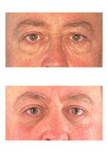 photos avant après Résultat chirurgie Dr Pascal GRANIER : Paupieres inferieures - voie transconjonctivale - cure de lipoptose - poche sous les yeux