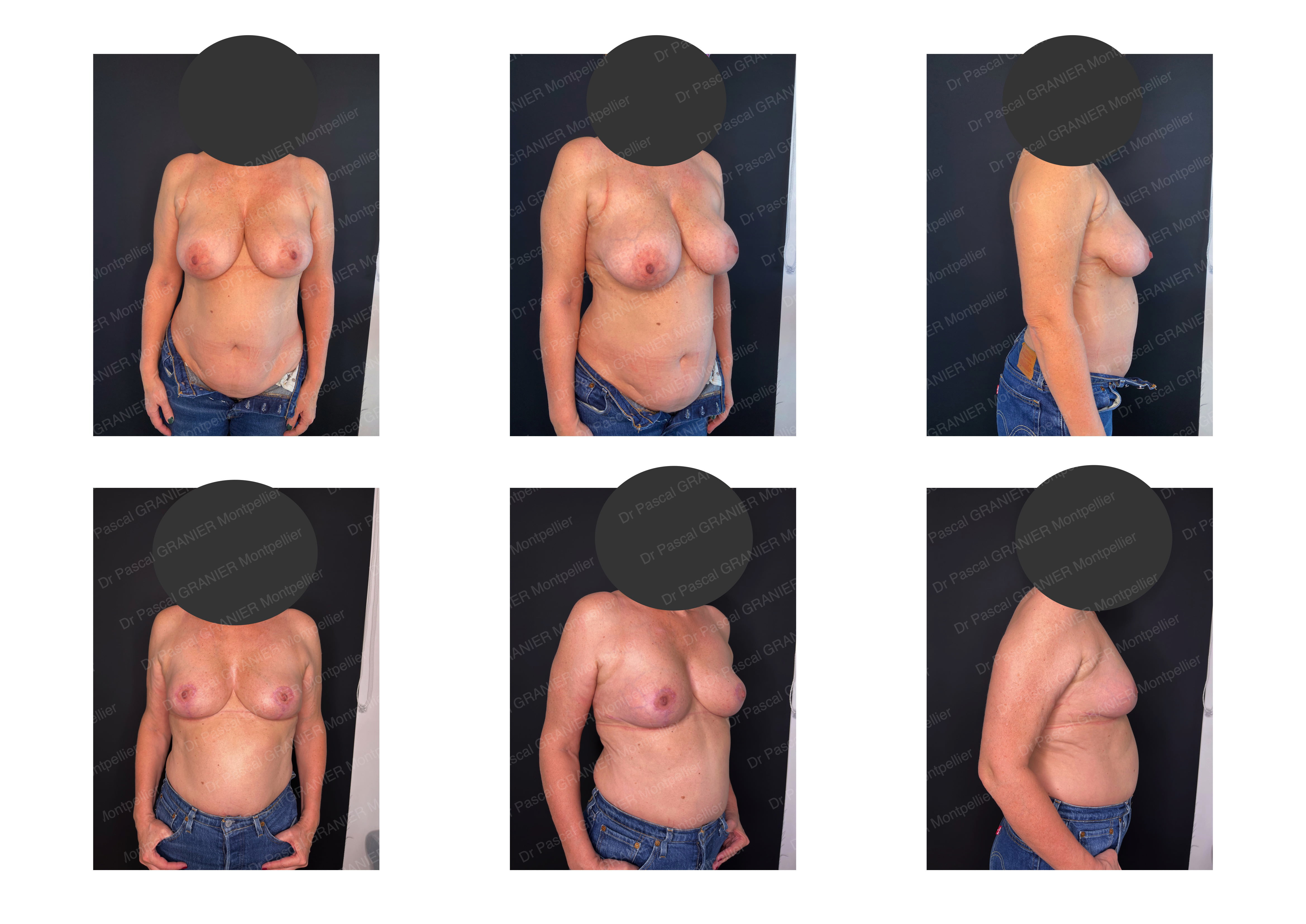 photos avant après Résultat chirurgie Dr Pascal GRANIER : Reduction mammaire 330 gr x 2