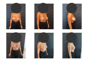 photos avant après Résultat chirurgie Dr Pascal GRANIER : Reduction mammaire 350 gr x 2