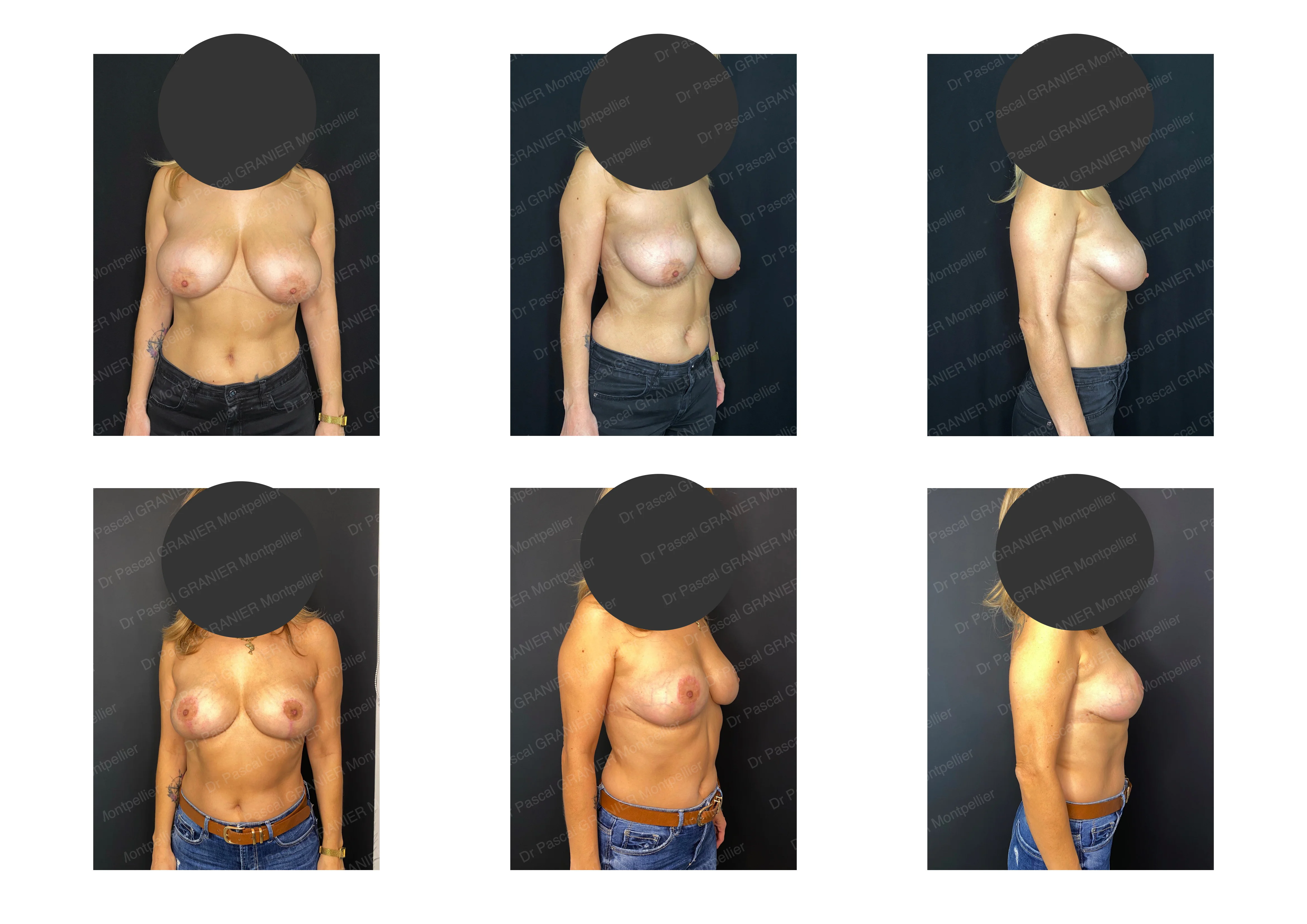 photos avant après Résultat chirurgie Dr Pascal GRANIER : Reduction mammaire asymetrique 200-300 gr