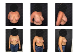 photos avant après Résultat chirurgie Dr Pascal GRANIER : Reduction mammaire en T 850 gr x 2